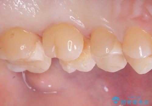 【セラミックインレー】詰め物が欠けたの治療中