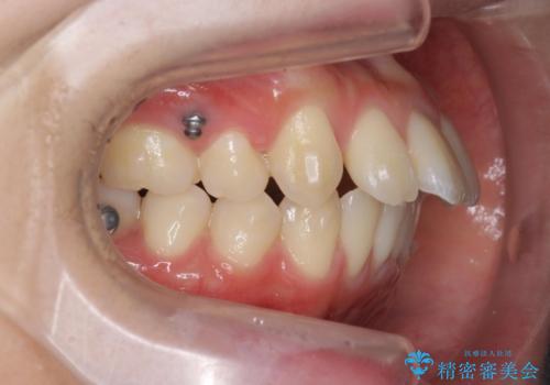 突き出た前歯の改善!マウスピースで再矯正の治療中