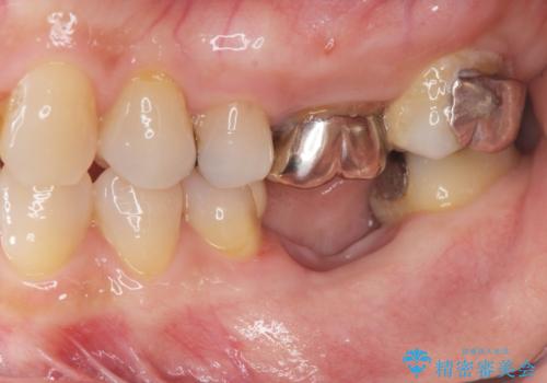 抜歯後の補綴 セラミックブリッジ治療の治療前