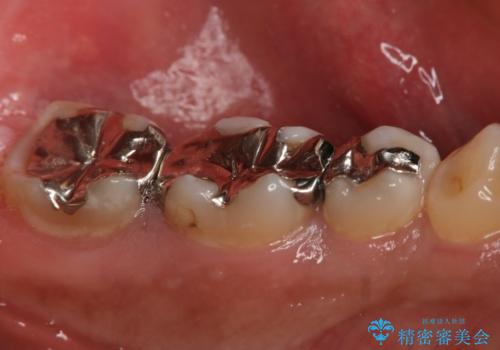 フルジルコニアクラウンによる銀歯のやり変えの治療前