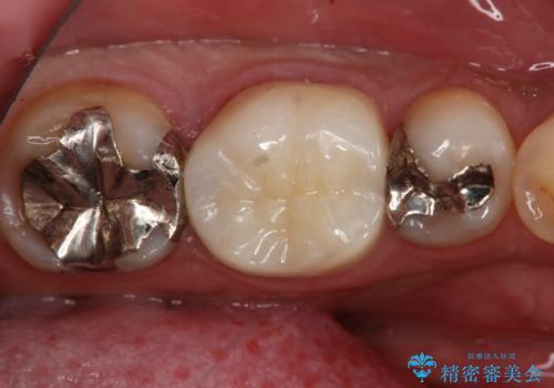 フルジルコニアクラウンによる銀歯のやり変え