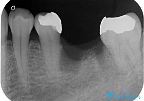 抜歯後の補綴 セラミックブリッジ治療の治療前