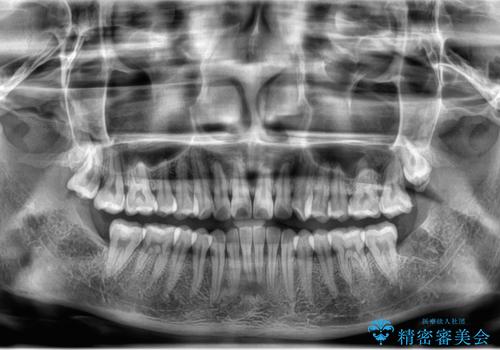 左下の親知らずが腫れた感じがする。の治療後