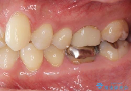 汚れの溜まりやすい銀歯を精度の高いセラミック治療で改善の治療前