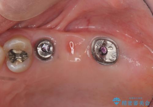 奥歯でしっかり噛める、インプラント治療の治療中
