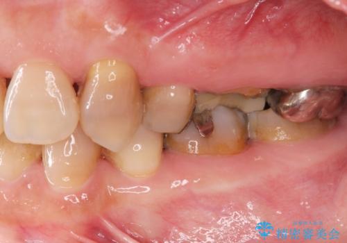 食いしばりが強い 歯周病全顎治療の治療前