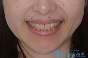 最小限の来院回数で歯並びを改善:インビザライン治療の治療後(顔貌)