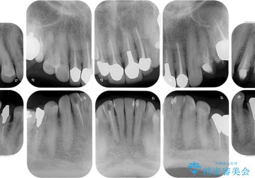 目立つ銀歯をセラミックに 奥歯の審美歯科治療の治療前