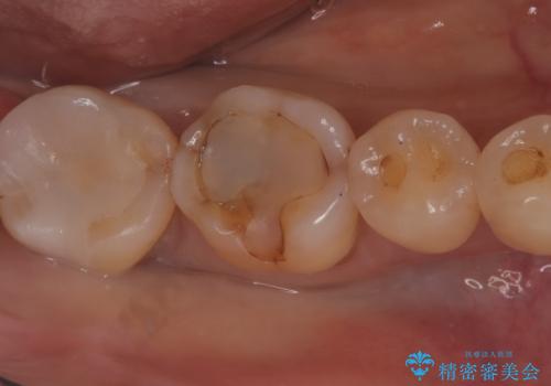【セラミックインレー】プラスチックの劣化が気になるの治療後