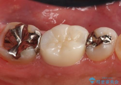 フルジルコニアクラウンによる銀歯のやり変えの治療後