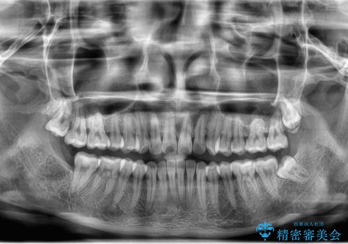 左下の親知らずが腫れた感じがする。の治療前