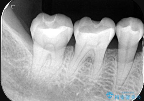 【セラミックインレー】プラスチックの劣化が気になるの治療後