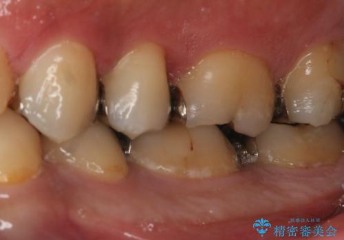 フルジルコニアクラウンによる銀歯のやり変えの治療前