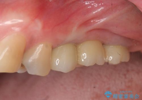 奥歯でしっかり噛める、インプラント治療の治療後