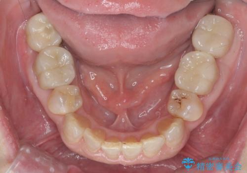 食いしばりが強い 歯周病全顎治療の治療後