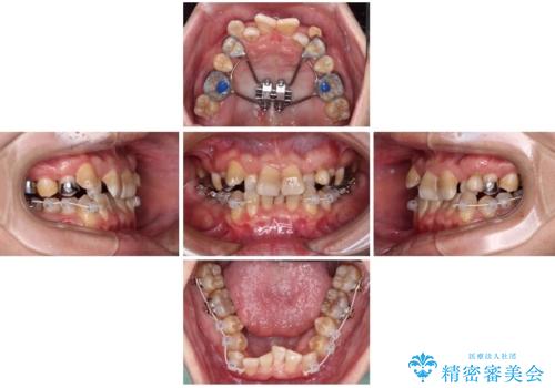 全体的なデコボコが気になる。拡大装置を併用したワイヤー矯正の治療中