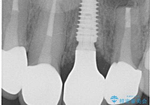 前歯4本のセラミック治療|抜歯即時インプラント+歯根端切除術で機能と美しさを回復の治療後