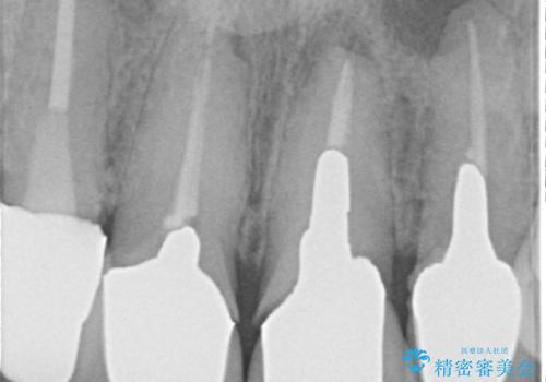 前歯4本のセラミック治療|抜歯即時インプラント+歯根端切除術で機能と美しさを回復の治療前