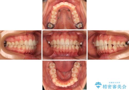 【モニター】突出した前歯 補助装置を併用したインビザライン矯正の治療中