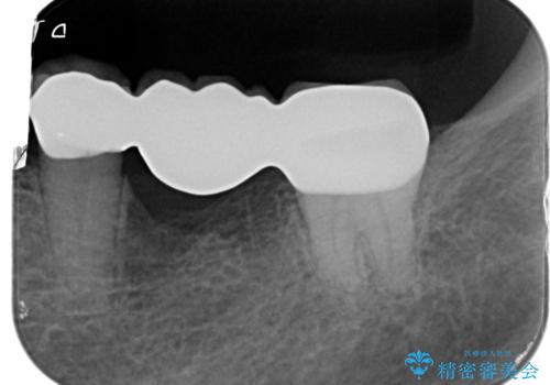 抜歯後の補綴 セラミックブリッジ治療の治療後