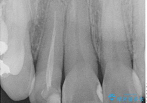 前歯の見た目が気になる|オールセラミッククラウンで見た目を改善の治療前