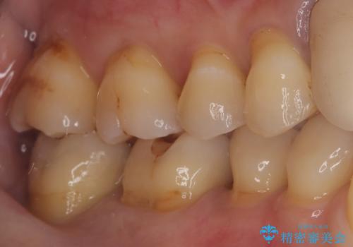 【セラミックインレー】プラスチックの劣化が気になるの治療後