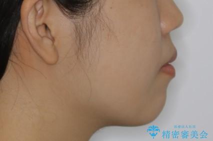 インビザラインが使えなかった:ワイヤーで仕上げ治療の治療後(顔貌)