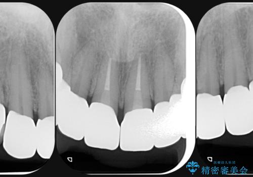 [ 審美歯科 ] 前歯セラミック治療の再治療の治療後