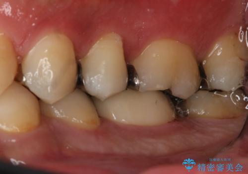 フルジルコニアクラウンによる銀歯のやり変えの治療後