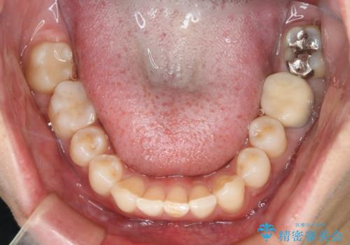 銀歯を白くしたい フルジルコニアクラウンとセラミックインレーの治療後