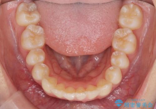 突き出た前歯の改善!マウスピースで再矯正の治療後