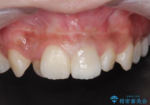 前歯の見た目が気になる。の治療後