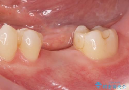 欠損部のインプラント補綴の症例 治療前