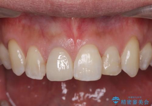 奥に引っ込んでいる前歯を並べたい 矯正治療とセラミック治療の治療後