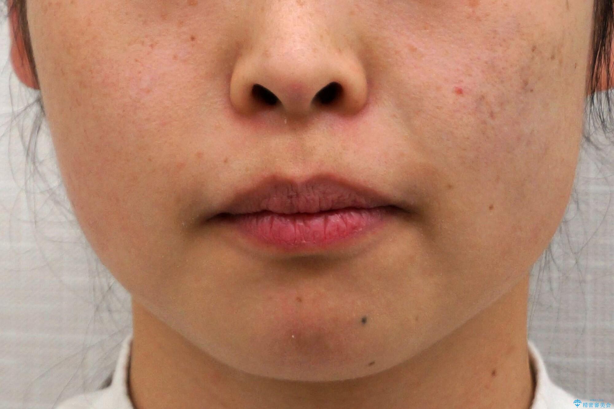 出っ歯の治療 抜かずに 短期間で目立たない治療の治療前(顔貌)