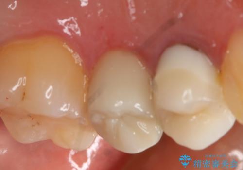 う蝕除去中に露髄 フルジルコニアクラウンの治療後