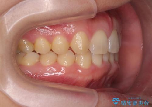 前歯のすき間 歯のがたつきの治療中