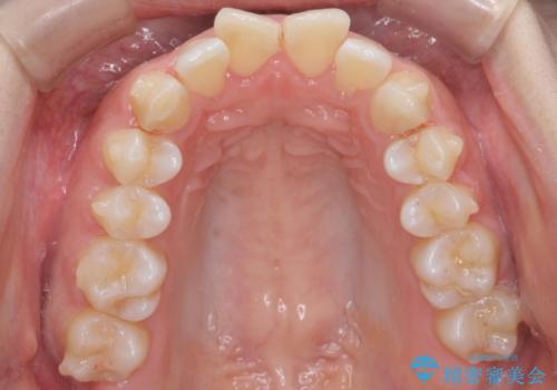 出っ歯の治療 抜かずに 短期間で目立たない治療の治療中