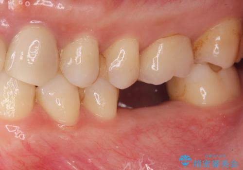 欠損部のインプラント補綴の治療前