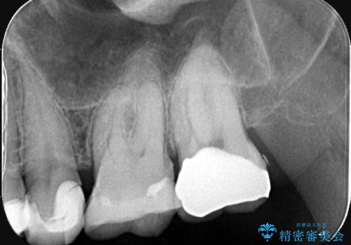 左上7のメタルインレーを除去|セラミッククラウンで自然な美しさと機能回復の治療後