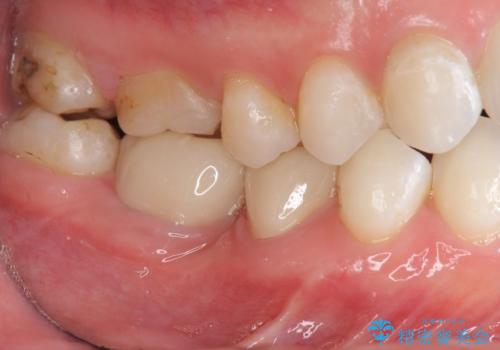 銀歯を白くしたい セラミック治療の治療後