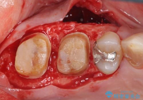 歯周ポケットの除去と再補綴治療の治療中