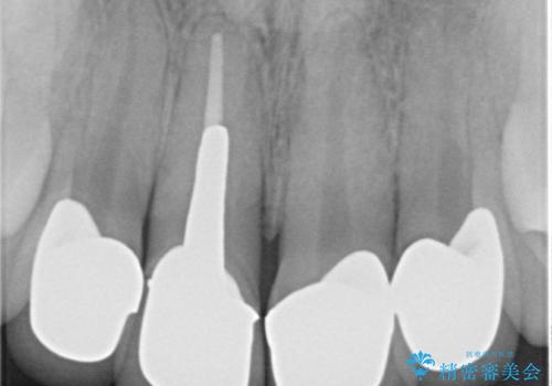 金属色の見える前歯 オールセラミックで審美治療の治療後