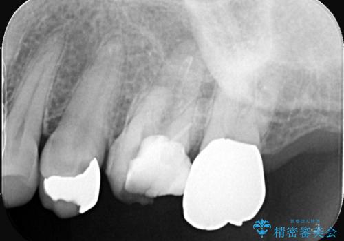 他院で治らなかった根管治療を精密治療で改善|MB2を発見し再治療の治療前