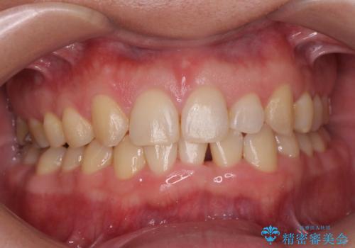 前歯のすき間 歯のがたつきの治療中