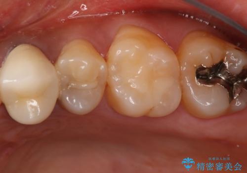 う蝕除去中に露髄 フルジルコニアクラウンの治療前