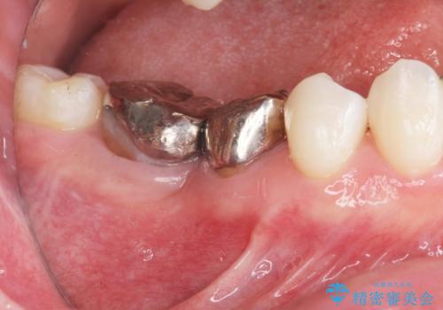 銀歯を白くしたい セラミック治療の症例 治療前