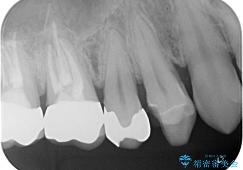 他院のセラミックインレー やり直し治療の治療前