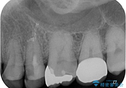 物が詰まる オールセラミッククラウンの治療前