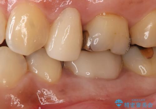 銀歯を白くしたい セラミックインレーの治療前